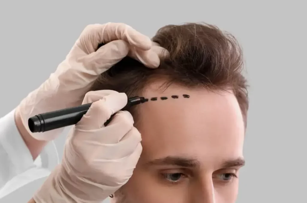 Hair Transplant Surgery: The Ultimate Guide To Regaining Confidence Hair Transplant Surgery The Ultimate Guide To Regaining Confidence