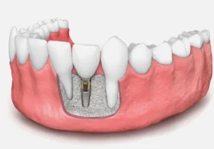Bone Grafting For Dental Implants Why It’s Sometimes Necessary