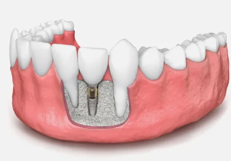 Bone Grafting For Dental Implants Why It’s Sometimes Necessary