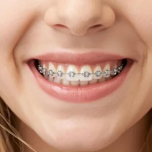 Why Clear Aligners Offer A Flexible Alternative To Braces