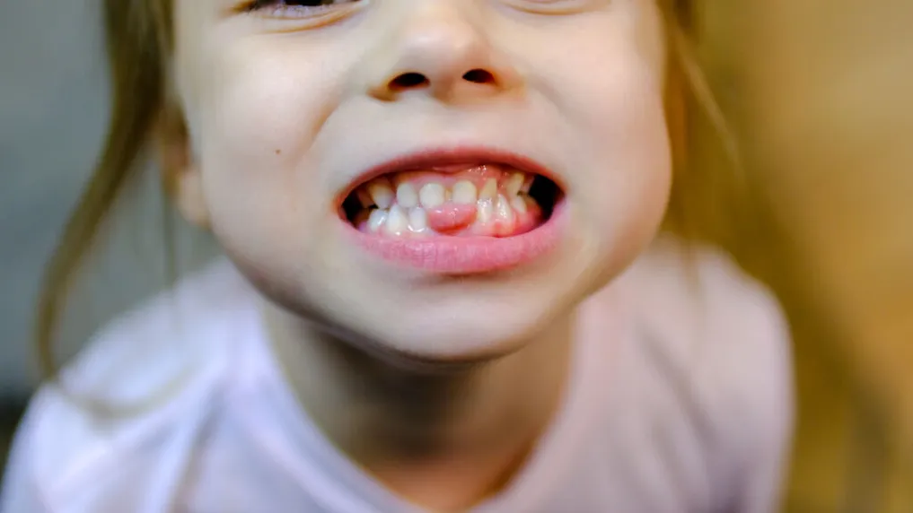 When “Crowded Baby Teeth” Predicts Future Orthodontic Needs When “Crowded Baby Teeth” Predicts Future Orthodontic Needs
