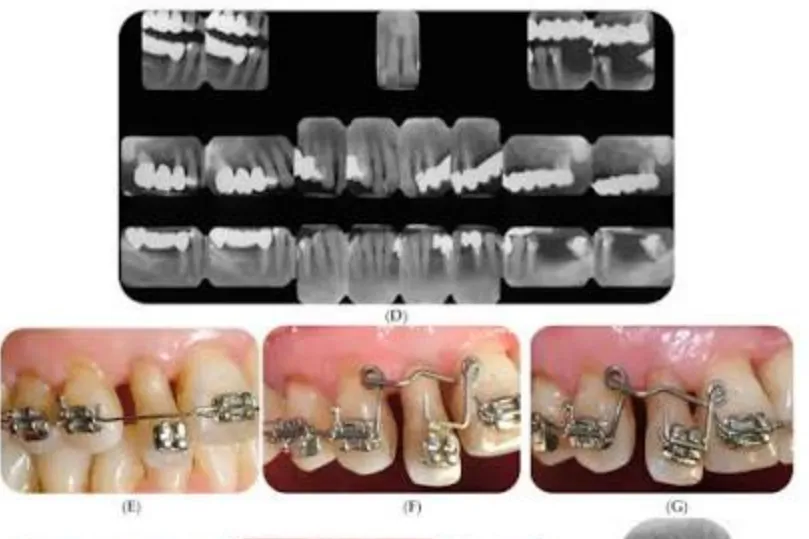 How Periodontists Support Orthodontic And Cosmetic Outcomes How Periodontists Support Orthodontic And Cosmetic Outcomes